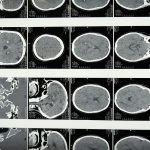 Proteina care ar putea accelera îmbătrânirea creierului. Ce au descoperit cercetătorii despre memorie și declinul cognitiv