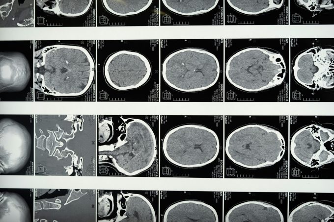 Proteina care ar putea accelera îmbătrânirea creierului. Ce au descoperit cercetătorii despre memorie și declinul cognitiv