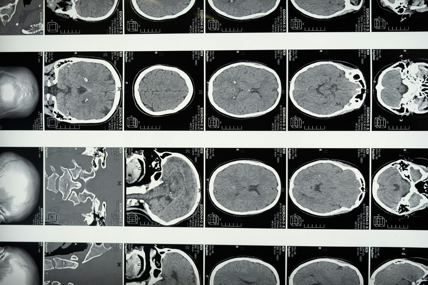 Proteina care ar putea accelera îmbătrânirea creierului. Ce au descoperit cercetătorii despre memorie și declinul cognitiv