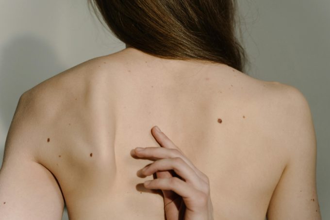 Studiu: Un plasture inteligent cu ioni de cupru ar putea trata melanomul fără operație