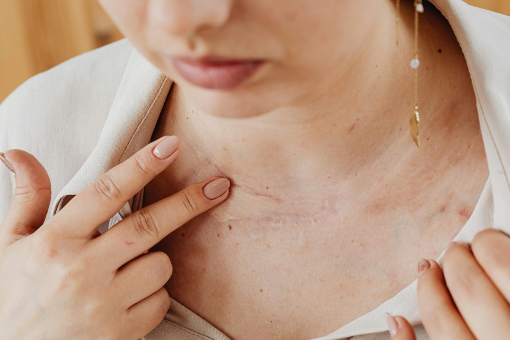 Studiu: Un plasture inteligent cu ioni de cupru ar putea trata melanomul fără operație