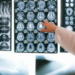 Studiu: Terapia cu ultrasunete ar putea crește șansele de supraviețuire după un AVC