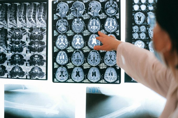 Studiu: Terapia cu ultrasunete ar putea crește șansele de supraviețuire după un AVC