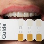 Cât de periculoase sunt benzile și cremele de albire a dinților cumpărate online. Avertismentul medicilor stomatologi