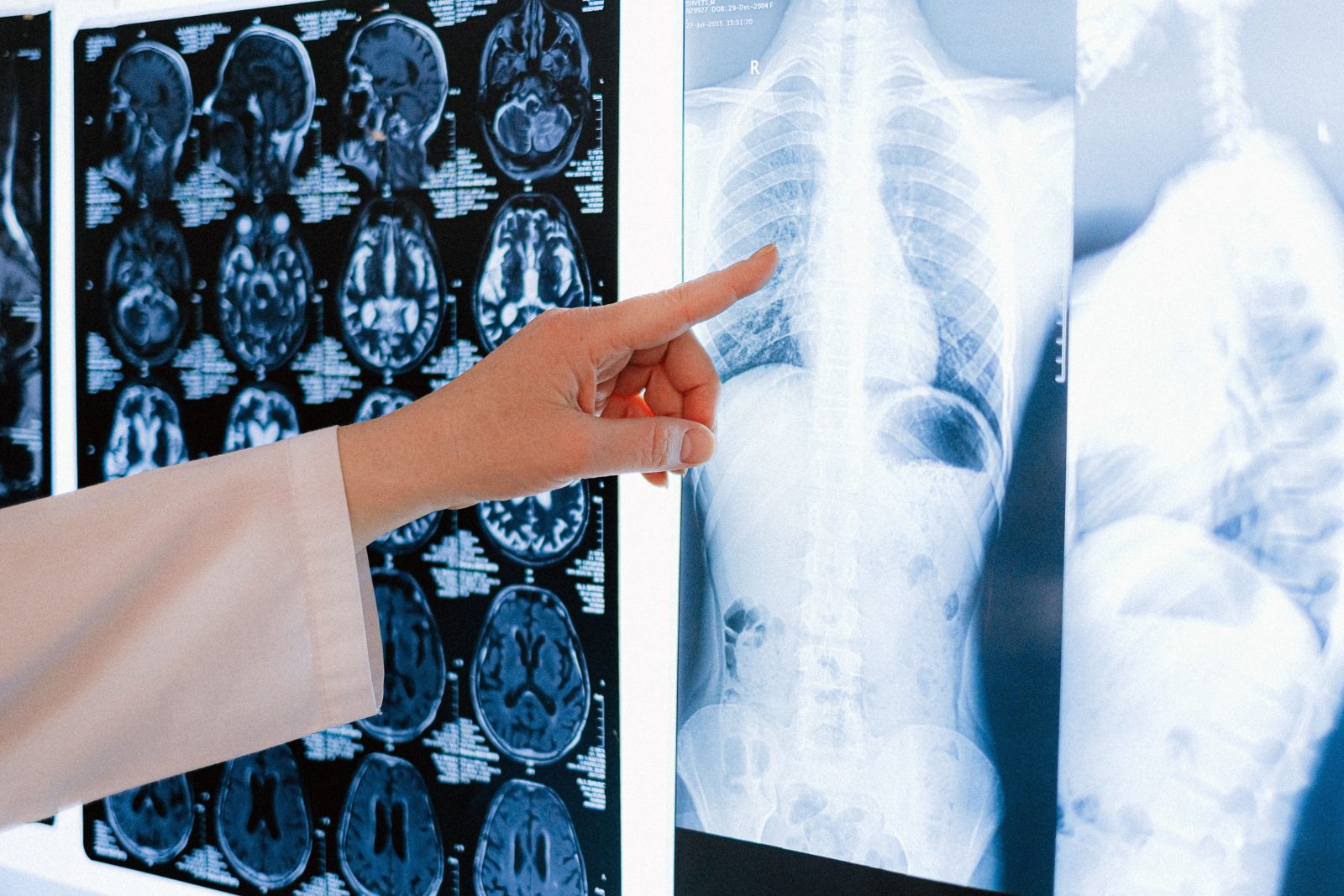 Silicoza revine în rândul muncitorilor. Boala pulmonară poate fi prevenită, dar continuă să provoace decese